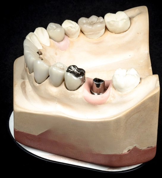 R&V Qualitätszahntechnik - Dentallabor - ein gegossenes Metallgerüst für eine herausnehmbare Teilprothese,