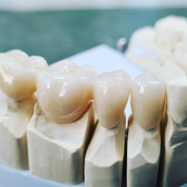 R&V Qualitätszahntechnik - Dentallabor - ein gegossenes Metallgerüst für eine herausnehmbare Teilprothese,