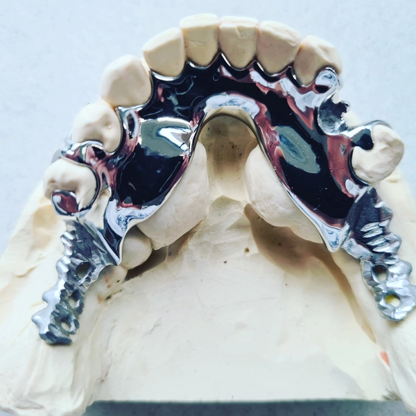 R&V Qualitätszahntechnik - Dentallabor - ein gegossenes Metallgerüst für eine herausnehmbare Teilprothese,