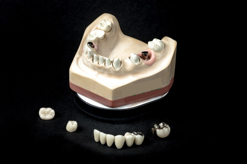 R&V Qualitätszahntechnik - Dentallabor - ein gegossenes Metallgerüst für eine herausnehmbare Teilprothese,